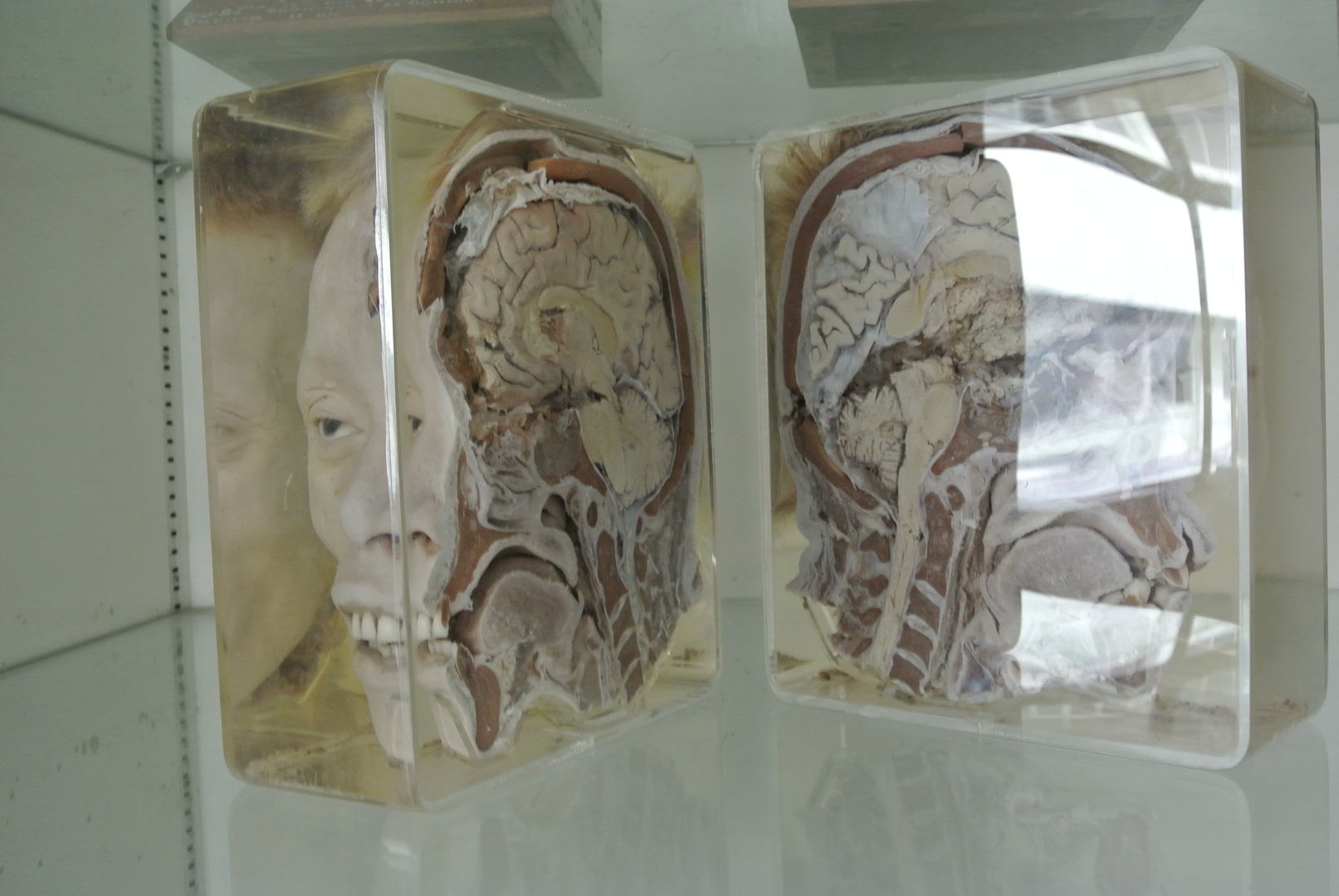 Bangkok, Le Siriraj Museum ou le Musée des curiosités médicales